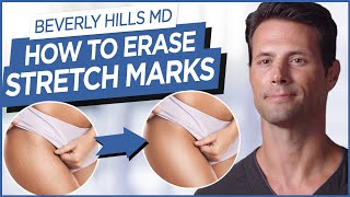 How To Get Rid Of Stretch Marks | Beverly Hills MD Beauty Tips