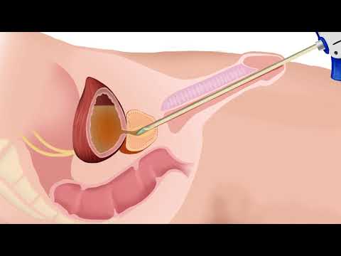 Video: Kan vergrote prostaat rugpyn veroorsaak?