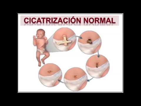 Video: ¿Cuándo se cae el cordón umbilical?