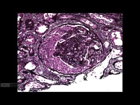 Video: Proteinase 3-antineutrophil Cytoplasmic Antibodi-necrotizing Positif Glomerulonephritis Crescentic Yang Rumit Oleh Endokarditis Berjangkit: Laporan Kes