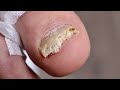 BYE BYE BYE Damaged Fungal Toenail REMOVAL