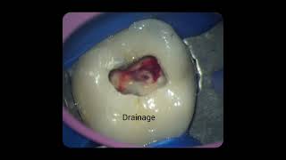 Negotiation of missed MB2 canal#mb2#rerct#endo##rct rctb