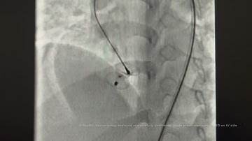 DrRAVIRT- VSD Device Closure using LT KONAR MFO VSD Device