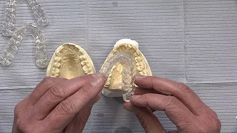 Case of the week: Various Occlusal Splint Possibil...
