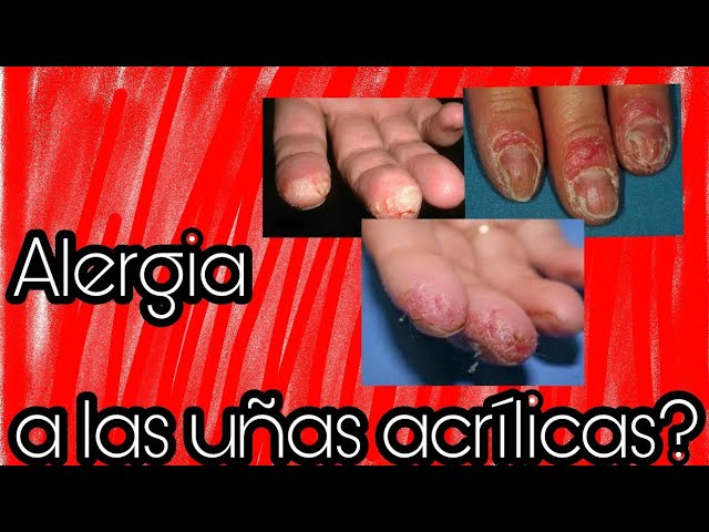 😪Alergias las uñas acrílicas. Mi experiencia👆 - YouTube
