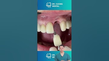 Cận cảnh cắm implant răng sứ | Bác sĩ Cường