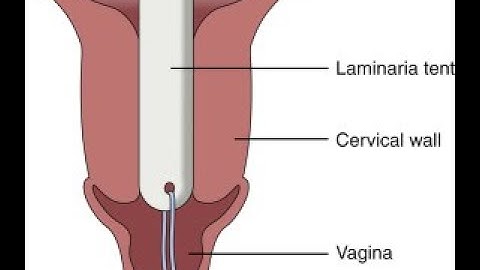 Induced Abortion cpt code - simplify medical coding