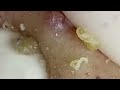 Small and cute nose blackhead viral relaxs   blackhead blackheads blackheadremoval