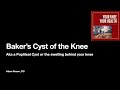 Baker's Cyst of the Knee