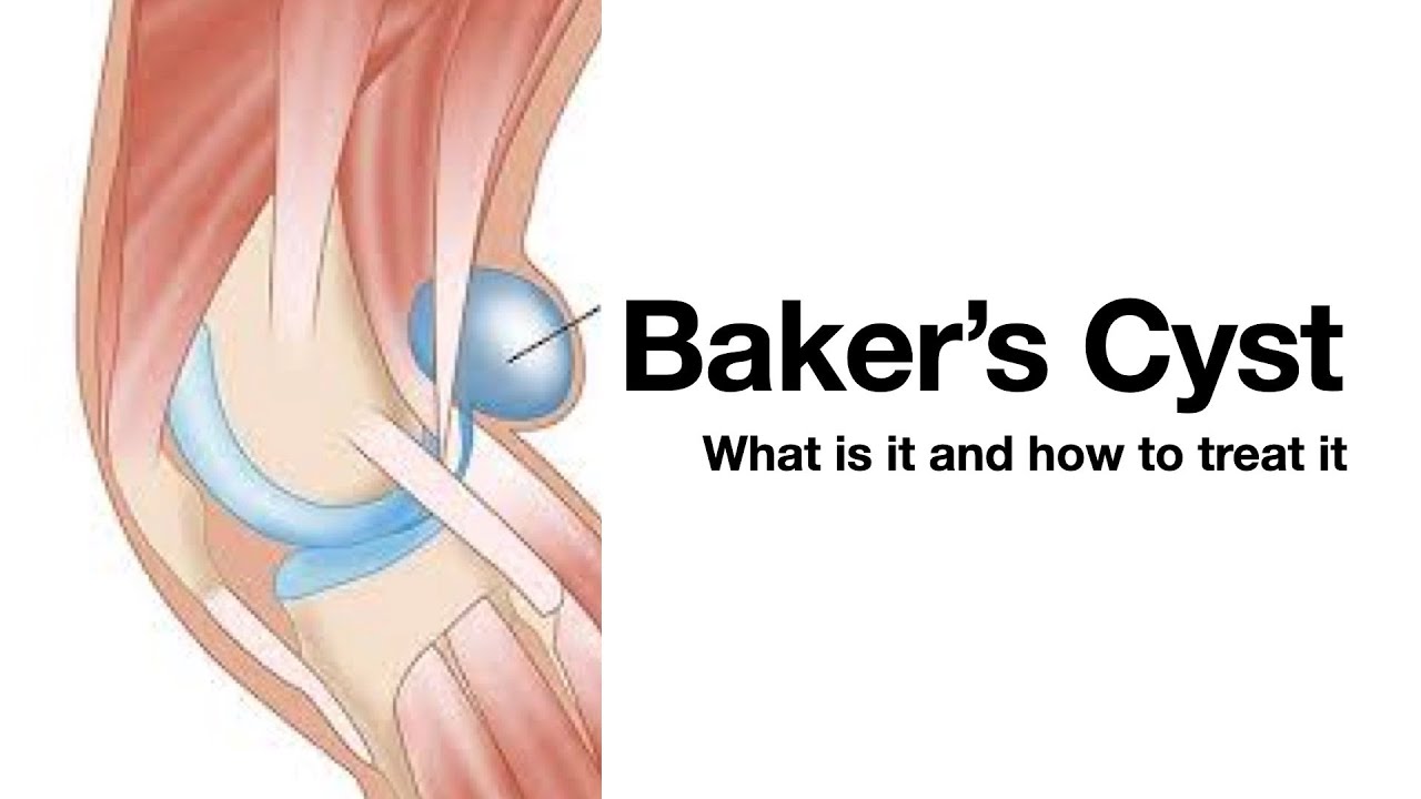 Baker's Cyst of the Knee aka popliteal cyst aka the lump behind your