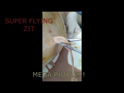 Popping Huge Pimples,Cysts,Boils,Zits !!! TOP 10 .Выдавливание прыщей.