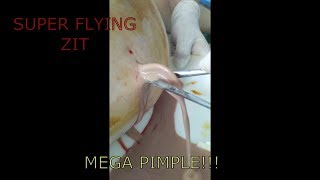 Popping Huge Pimples,Cysts,Boils,Zits !!! TOP 10 .Выдавливание прыщей.