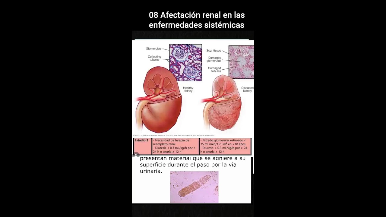 08 Afectación renal en las enfermedades sistémicas