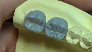 Live wax up - Lower 2nd molar (full)