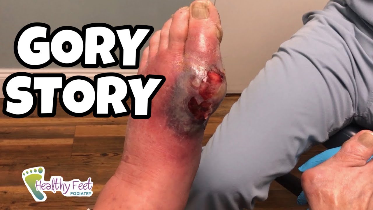 FLESH EATING BACTERIA ON THE FOOT! A GORY STORY– A DIABETIC FOOT CARE STORY