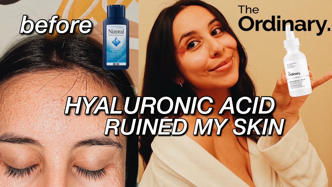 THE ORDINARY GAVE ME FUNGAL ACNE | + How Use Mask! The Ordinary Hyaluronic Acid 2%+B5 - YouTube