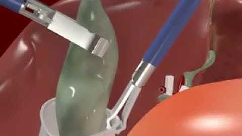 Phẫu thuật nội soi cắt túi mật