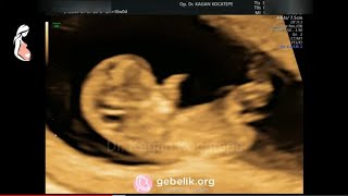 gebelik ilk uc ayinda yapilan ultrason