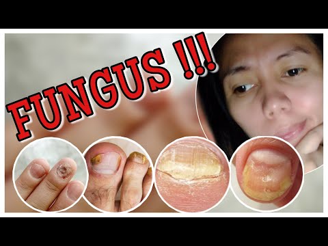 Video: 3 Mga Paraan upang Mapupuksa ang Fungus ng Kuko