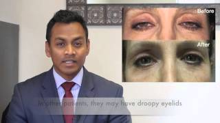 What is the difference between blepharoplasty and ptosis surgery?