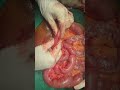 Laparotomy operation done by dr rajnish boss rk thakur hospital gopalganj medicalshorts laparotomy