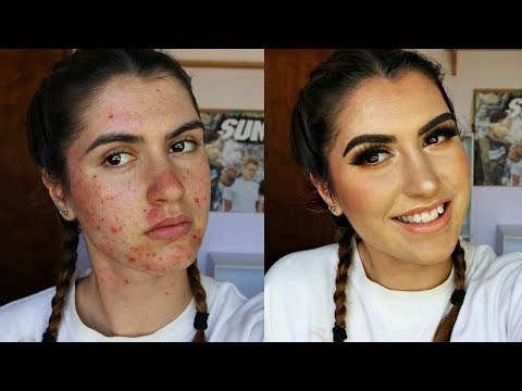 HOW TO COVER ACNE, SCARS & BREAKOUTS | Full Coverage w/ Drugstore Makeup