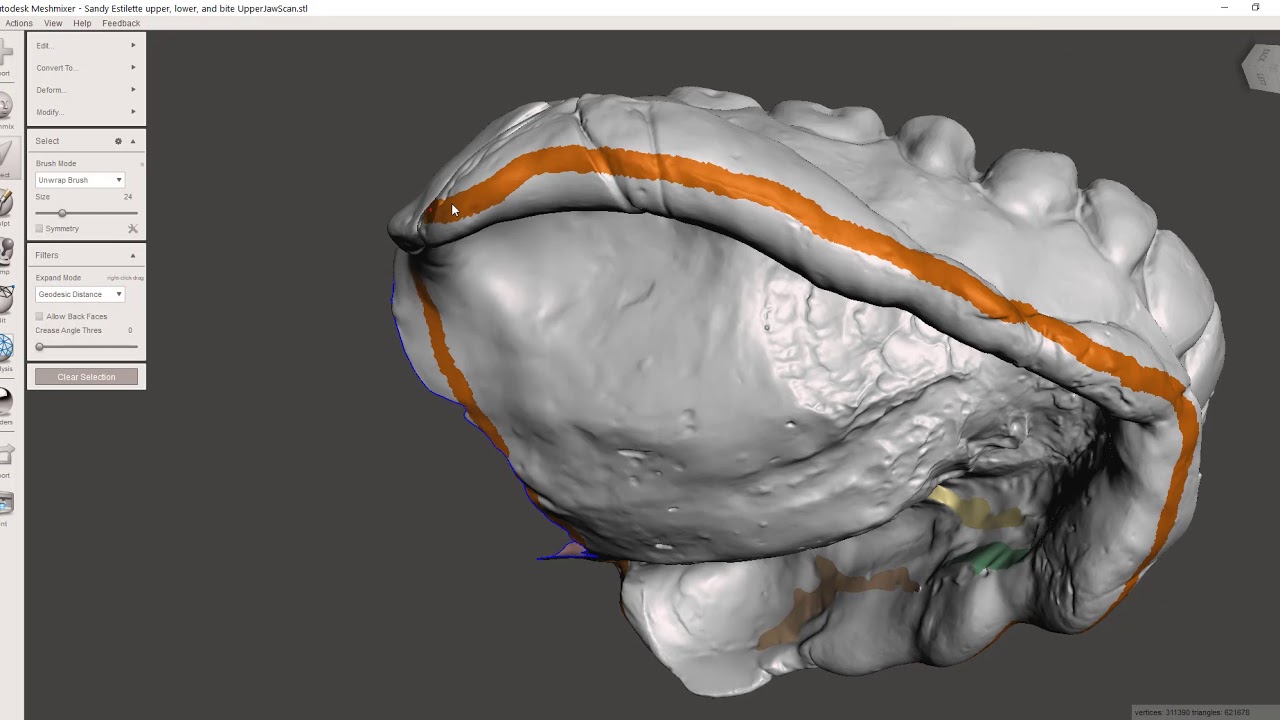 Inverting a Dental Impression Scan in Meshmixer