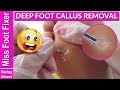 HOW TO REMOVE CALLUS FROM FOOT BY MISS FOOT FIXER