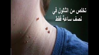 تخلص من الثآليل المزعجة في جسمك خلال نصف ساعة فقط عن طريق هذه العشبة الطبيعية