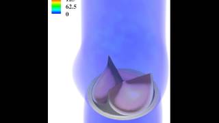 Celebrity Fluid-structure interaction simulation of a bioprosthetic heart valve Wealth
