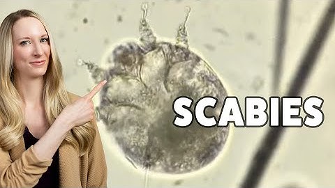 How to Treat Scabies Successfully: 5 Steps to Avoid Reinfection | Dr. Laura Soong - Dermatologist