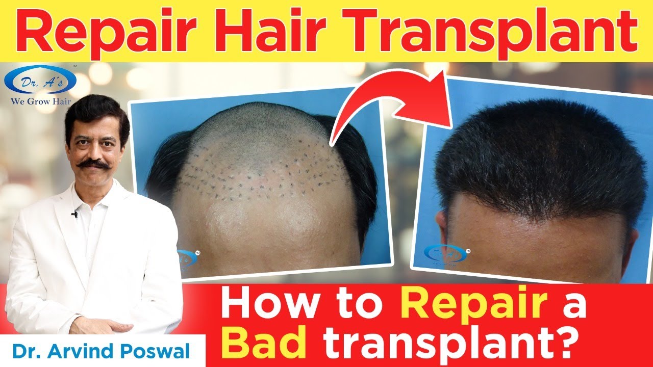 The Needs and Cost of Female Hair Transplant in Bhubaneswar by Radiance  Clinics  Issuu