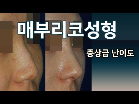 매부리코성형 - 중상급난이도 feat.전후사진