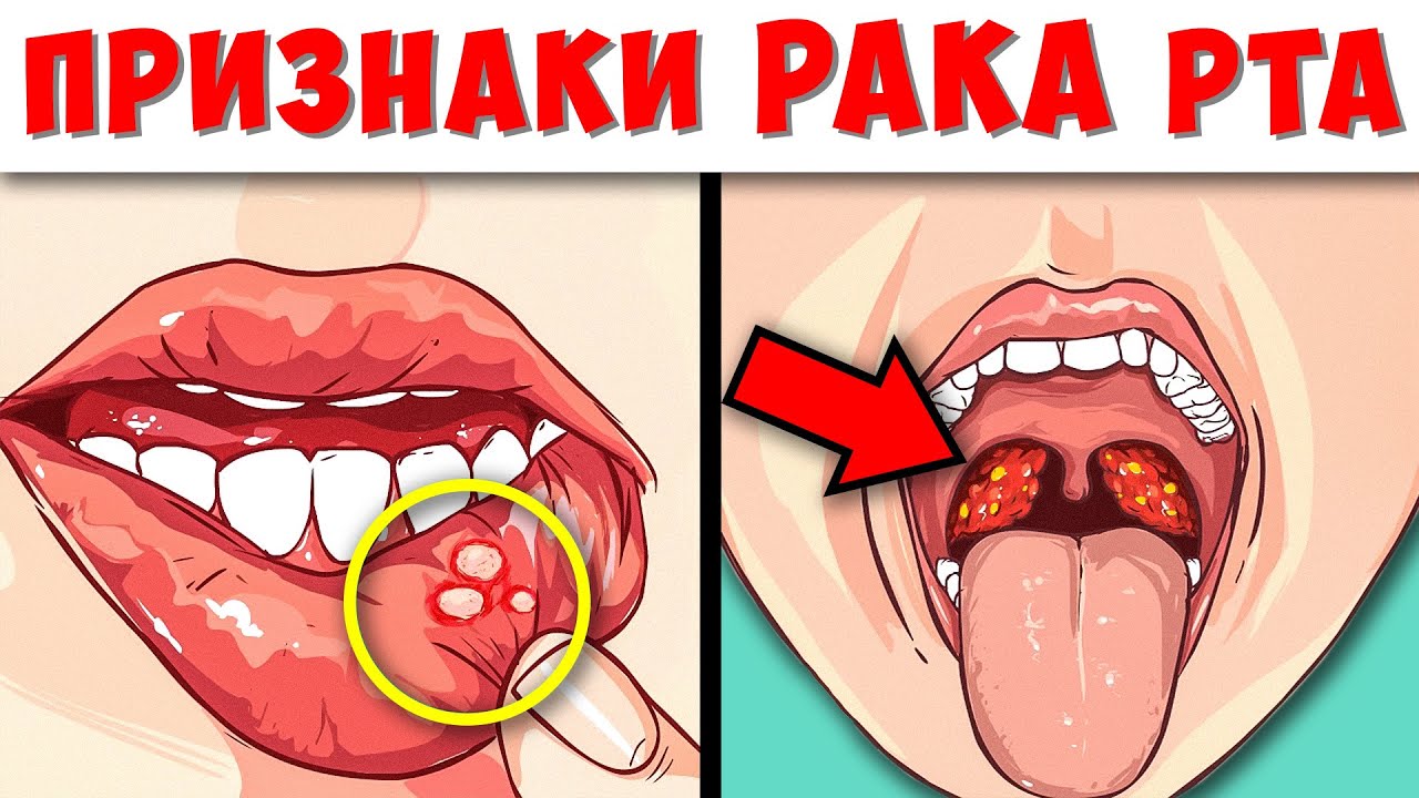 7 Ранних признака Рака полости Рта, которые часто Игнорируют и как ...