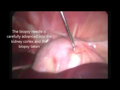 Renal biopsy