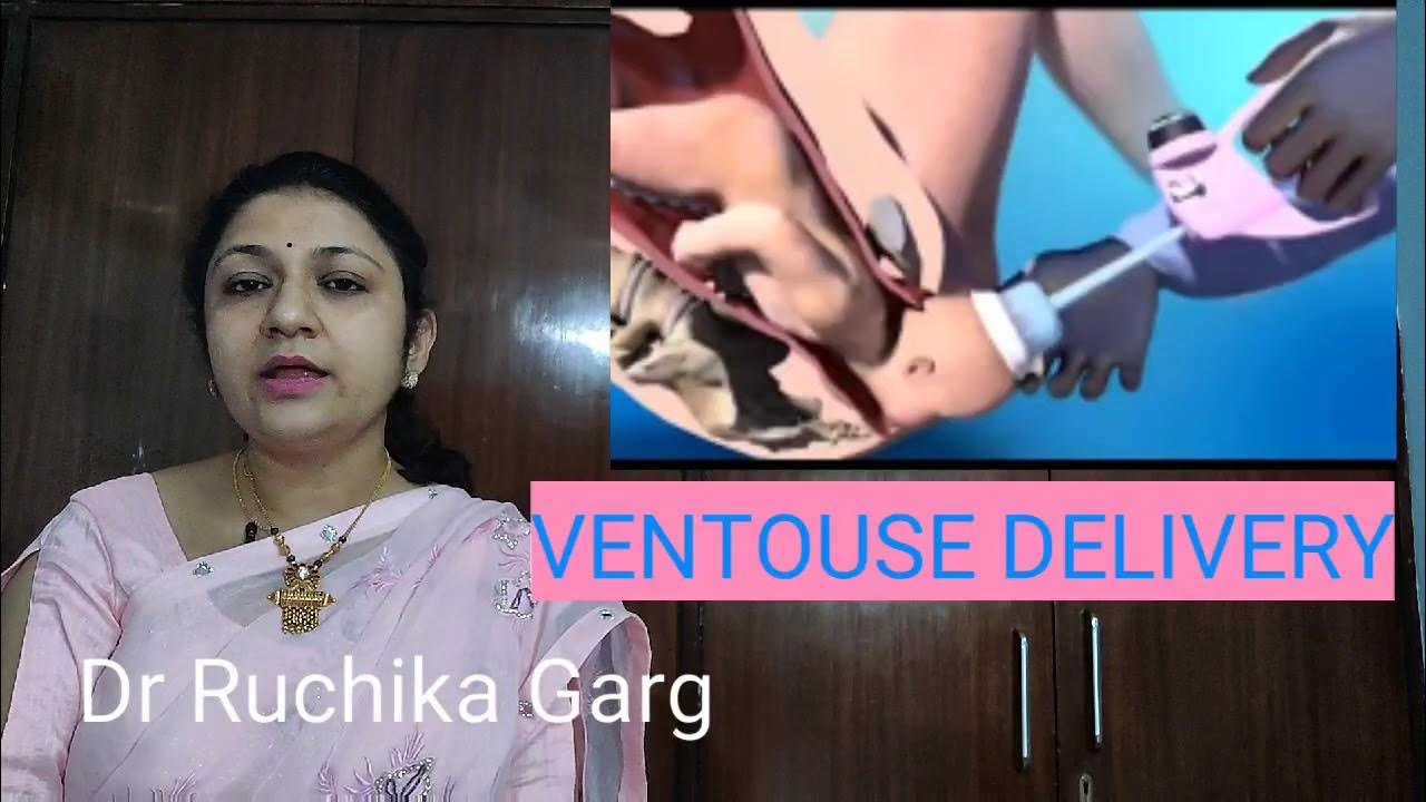 Ventouse Delivery Vacuum Delivery Obstetric Forceps Tutorial