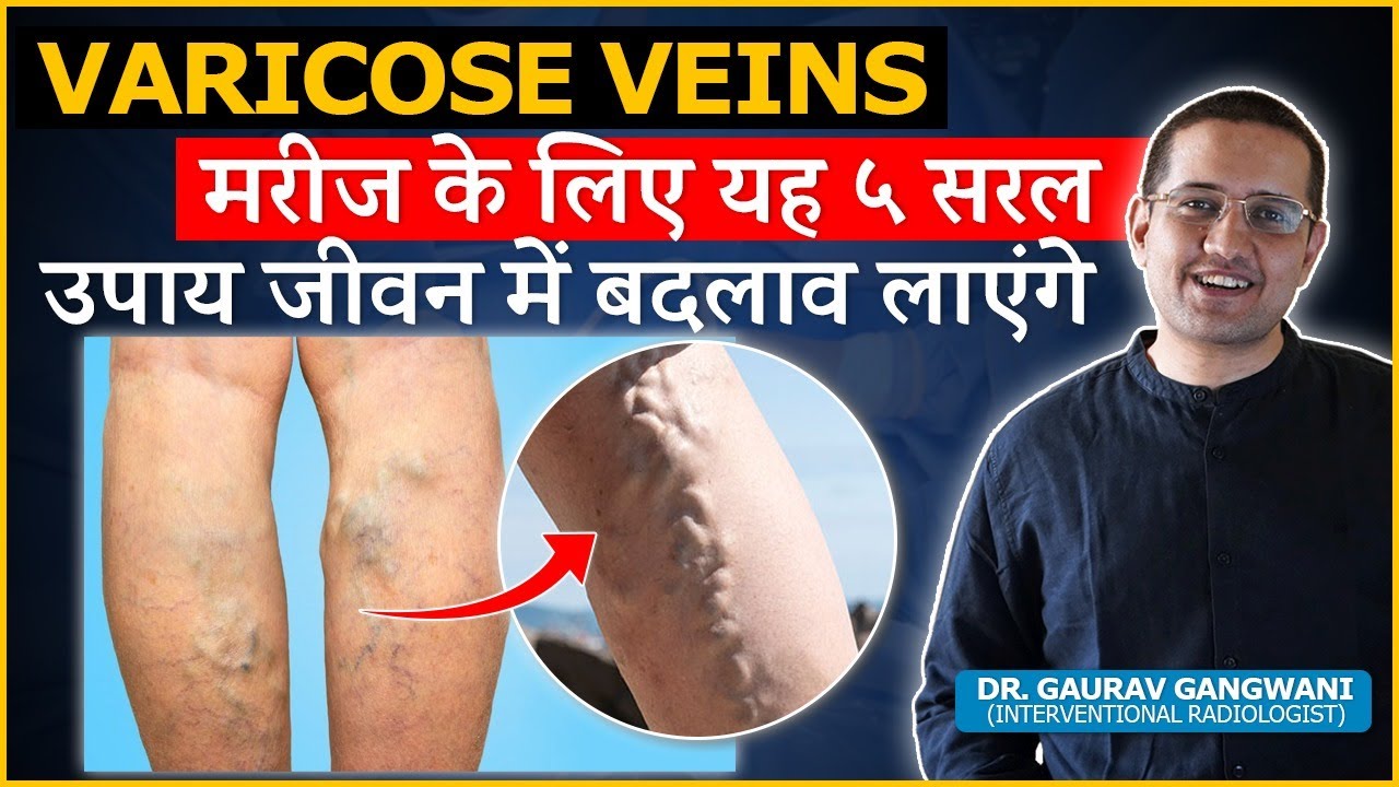 5 Simple Lifestyle Changes To Prevent Varicose Veins | Dr. Gaurav ...
