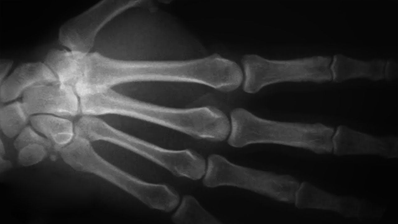 Что происходит с нашими сухожилиями и костями когда мы их ломаем