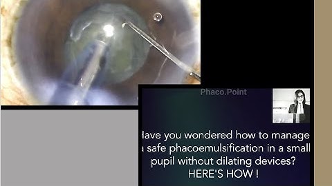 Safe and successful small pupil phacoemulsification without the aid of pupil dilating devices
