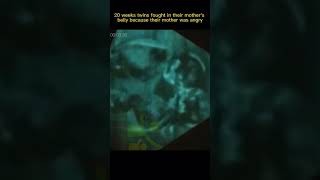 20 Week Twins Fetus Fought in the Mothers Belly pregnancy pregação shorts