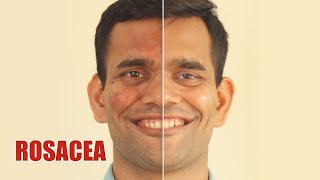 Herbal Treatment Of Rosacea That Really Works | Herbal Tips  for Redness on the face