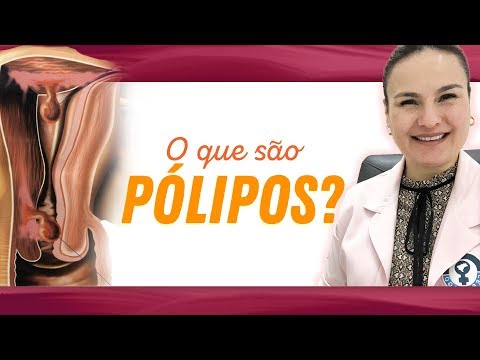 Vídeo: Pólipo Do Canal Cervical: Causas, Tratamento, Remoção
