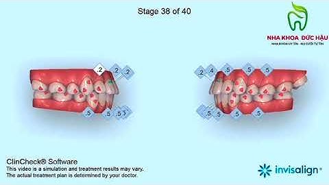 Biết trước kết quả với công nghệ ClinCheck Invisalign