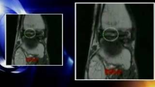 Eye on NY- Dr. Max Gomez looks at stem cell alternative to surgery