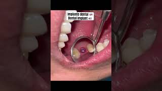 Implante dental 🦷 Dental Implant ✨ Costa Rica 🇨🇷