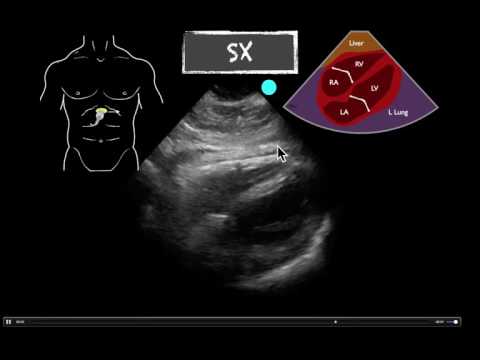 וִידֵאוֹ: מהו מספר echos ct?