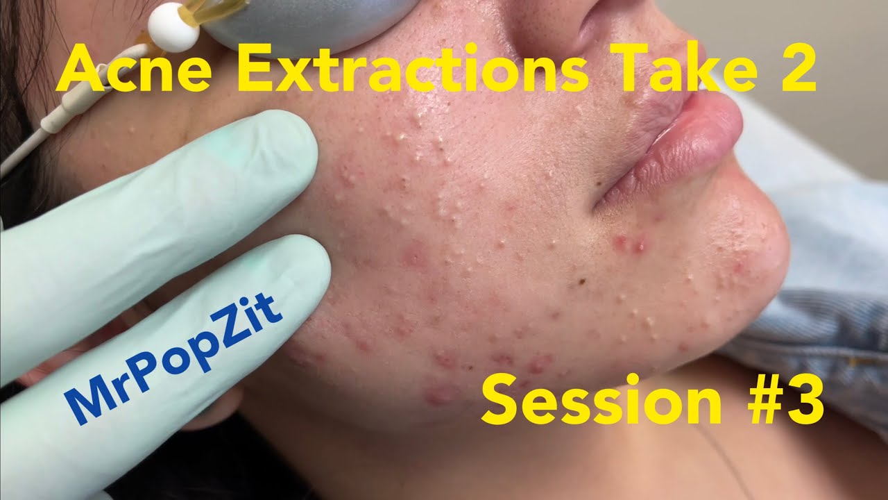 Acne extractions 2.0 session 3. Over 18 minutes edited down of just