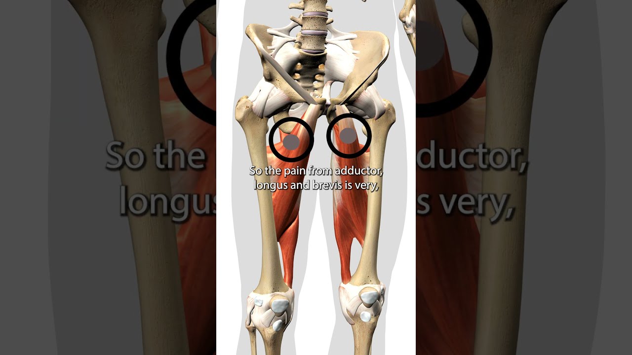 Hip Adductor Trigger Points