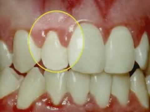 Image result for gum disease