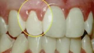 Periodontal Disease & Treatment